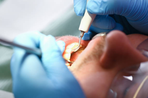 Best Emergency Root Canal Treatment in Miller, SD